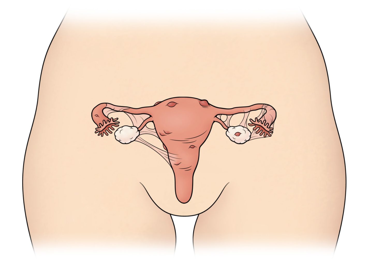 Endometriosis