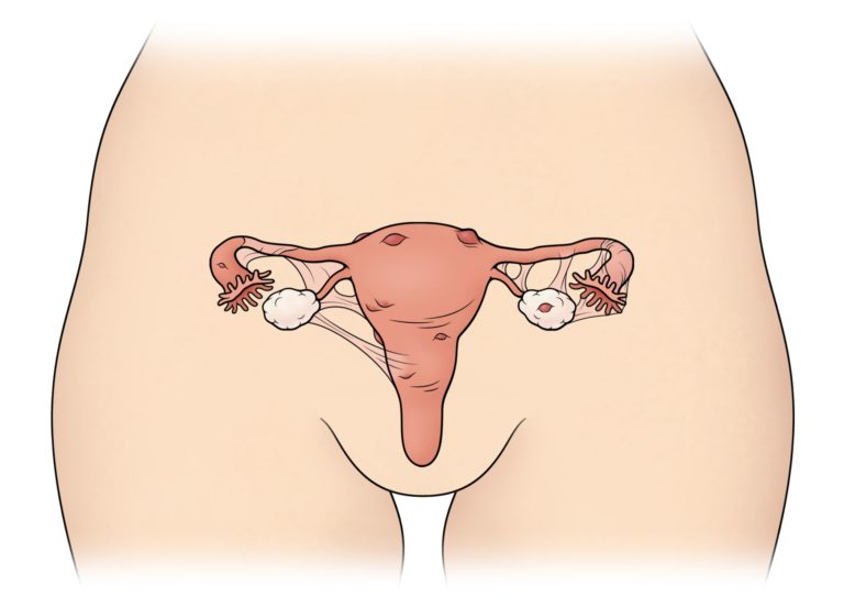 Endometriosis