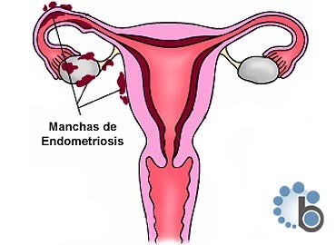 Reproduccion Bilbao - Endometriosis y calidad ovocitaria