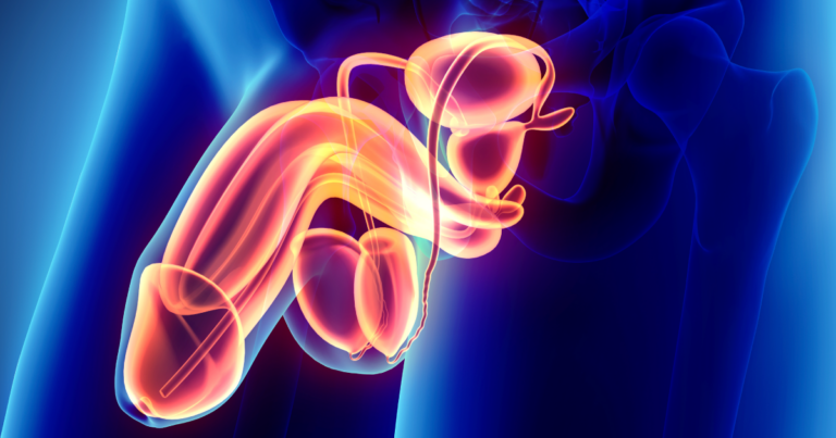 infertilidad masculina y varicocele
